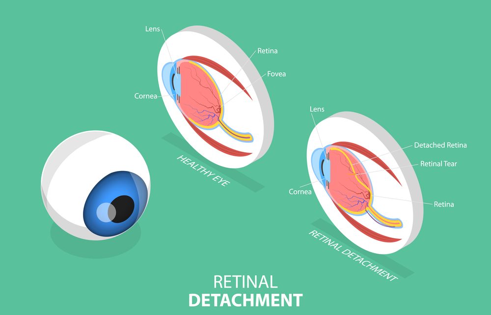 Diferencias entre desprendimiento de retina y de vítreo