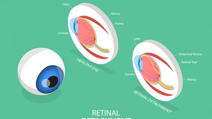 Diferencias entre desprendimiento de retina y de vítreo